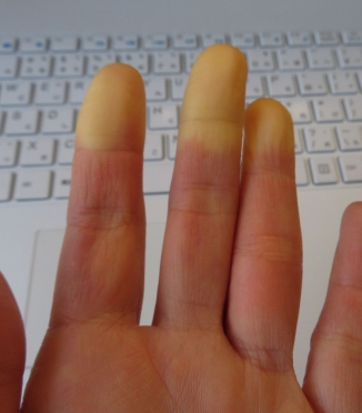 Raynaud sindroms un miegs — kāpēc naktīs rok rokas un kājas un kā ar to cīnīties