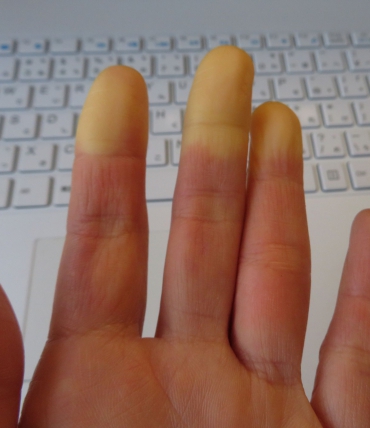 Raynaud sindroms un miegs — kāpēc naktīs rok rokas un kājas un kā ar to cīnīties